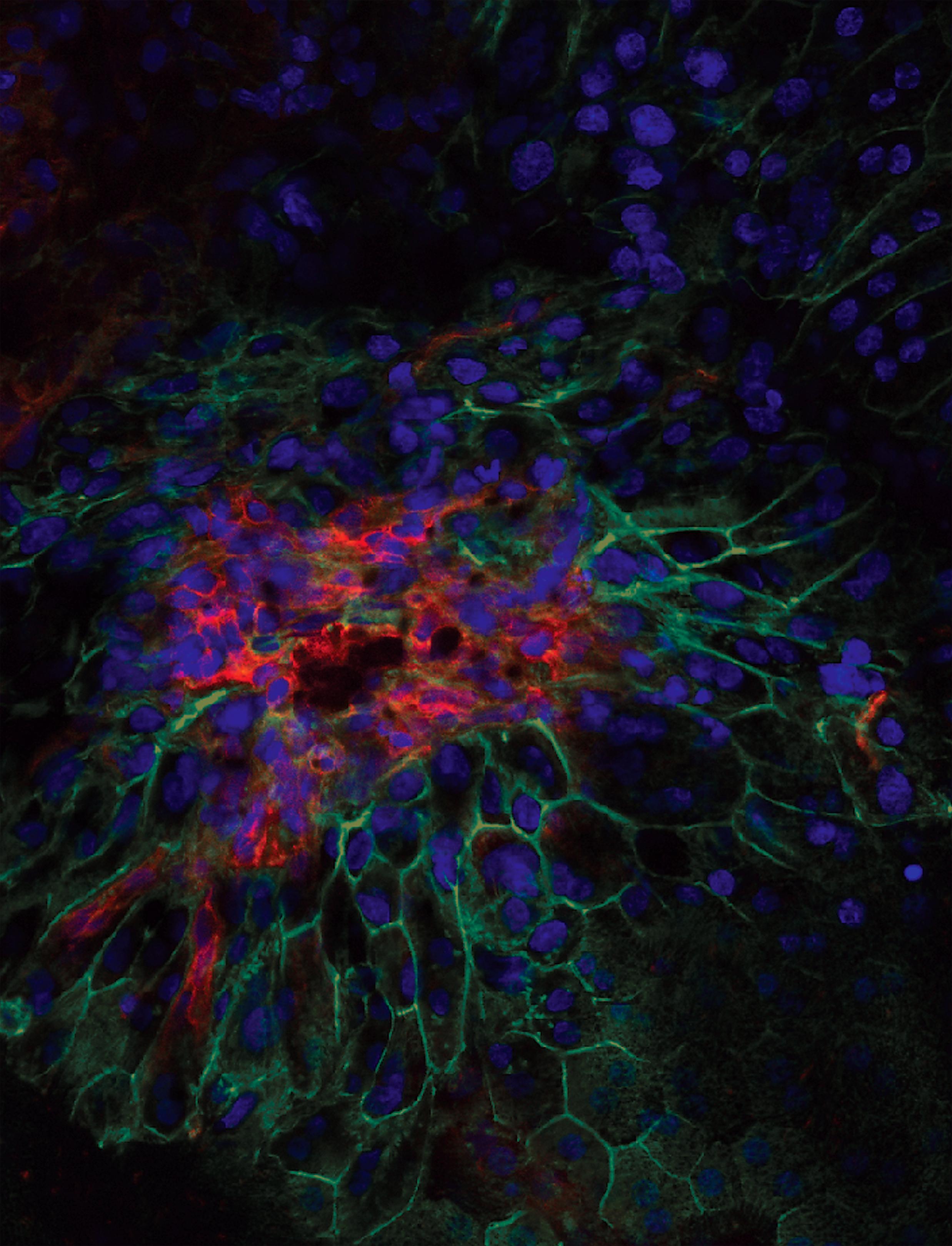 Confocal image of abnormal blood vessels invading the retina in wet AMD.