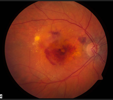 Fundus photograph showing drusen deposits in dry AMD.