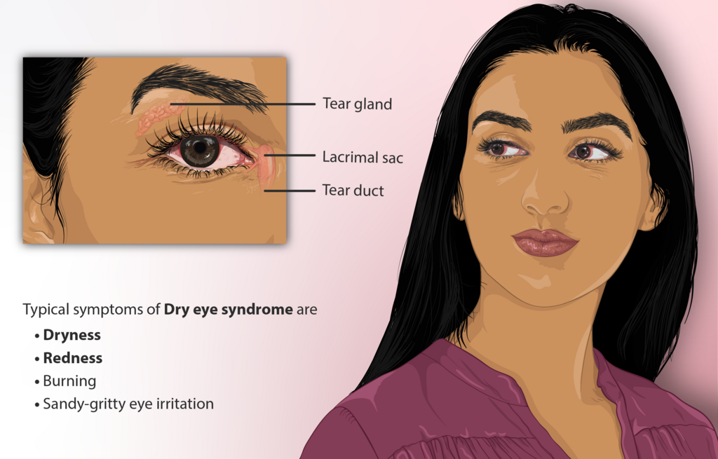 Illustration of dry eye symptoms around the eyelids and tear system