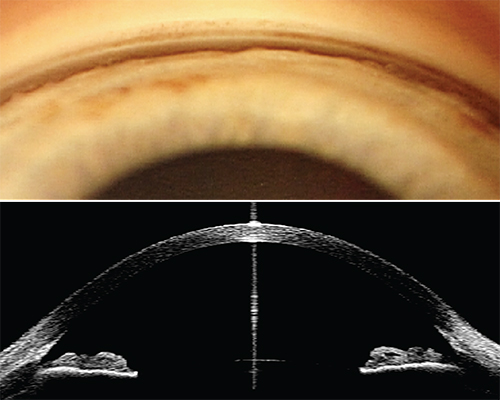 Composite image of gonioscopic view (top) and anterior-segment OCT (bottom) demonstrating a closed drainage angle.