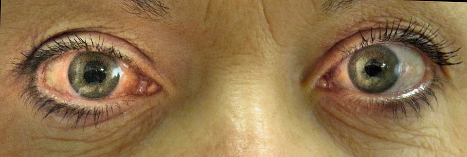 Patient with acute angle-closure glaucoma showing red, painful eyes and mid-dilated pupils.
