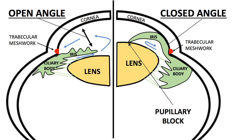 Side-by-side diagram showing an open drainage angle versus the blocked angle in pupillary-block glaucoma.