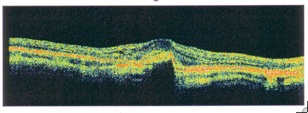 Optical coherence tomography scan showing fluid in the retina