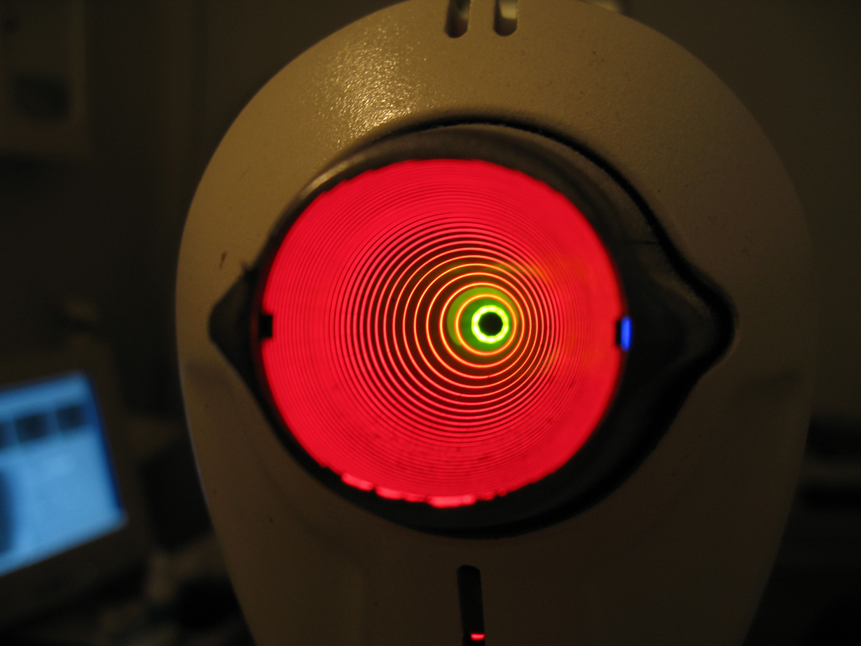 Placido disk rings reflected on the cornea during computerized corneal topography