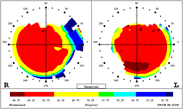 Color-coded tangential corneal curvature map showing steep and flat areas