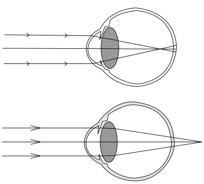 Diagram comparing normal vision and myopia
