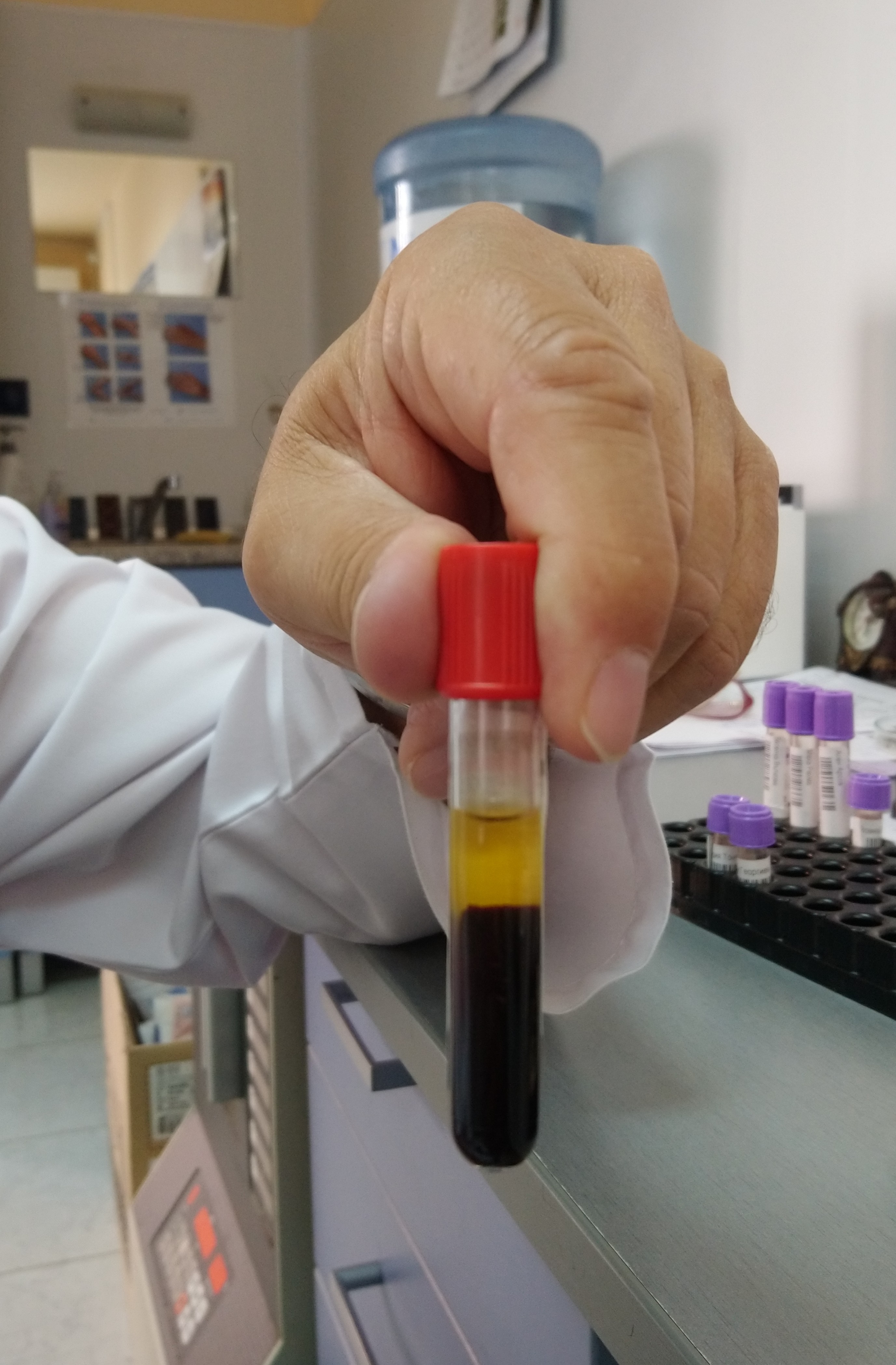 Serum-separating blood collection tube showing yellow serum and red cells