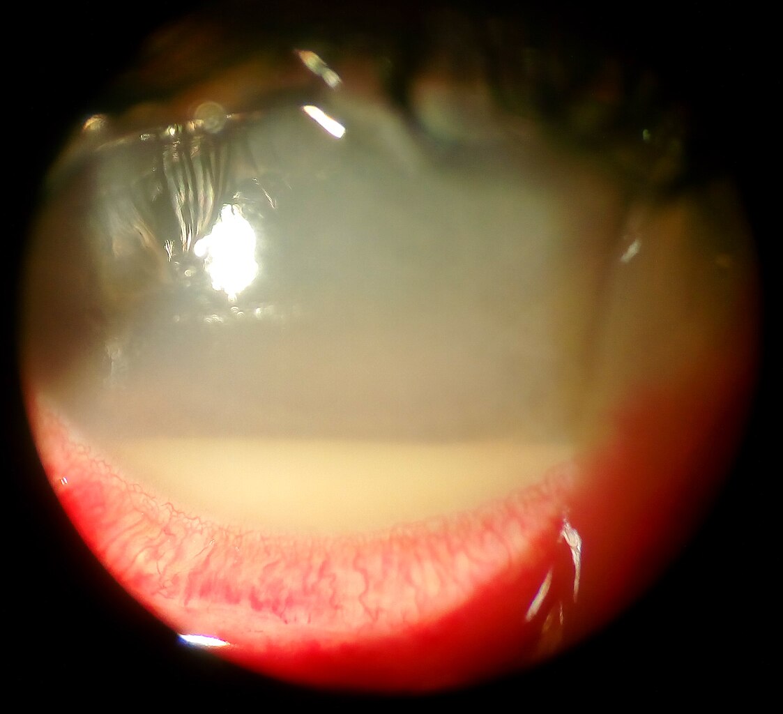 Slit-lamp view showing a hypopyon, a white fluid level in the front of the eye