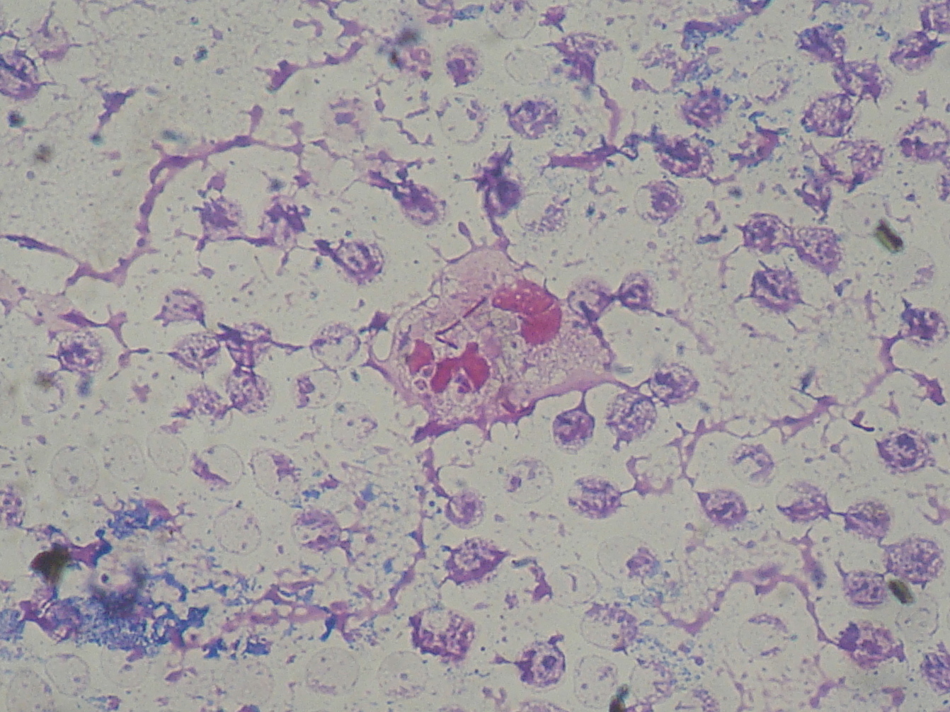 Gram-stained smear showing Pseudomonas aeruginosa with immune cells