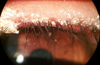 Crusting at eyelash roots in anterior blepharitis.