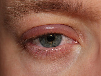 Mild blepharitis causing redness of the upper eyelid.