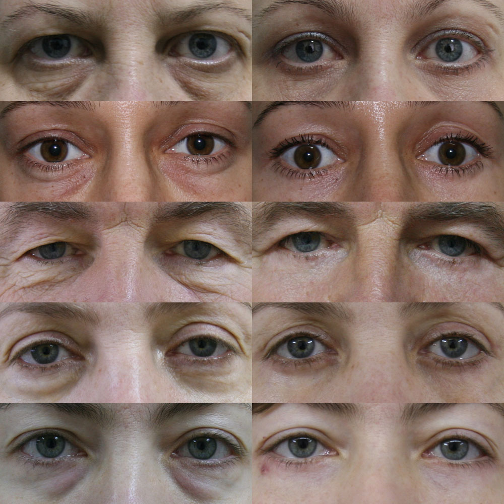 Before and after collage showing eyelids pre- and post-blepharoplasty