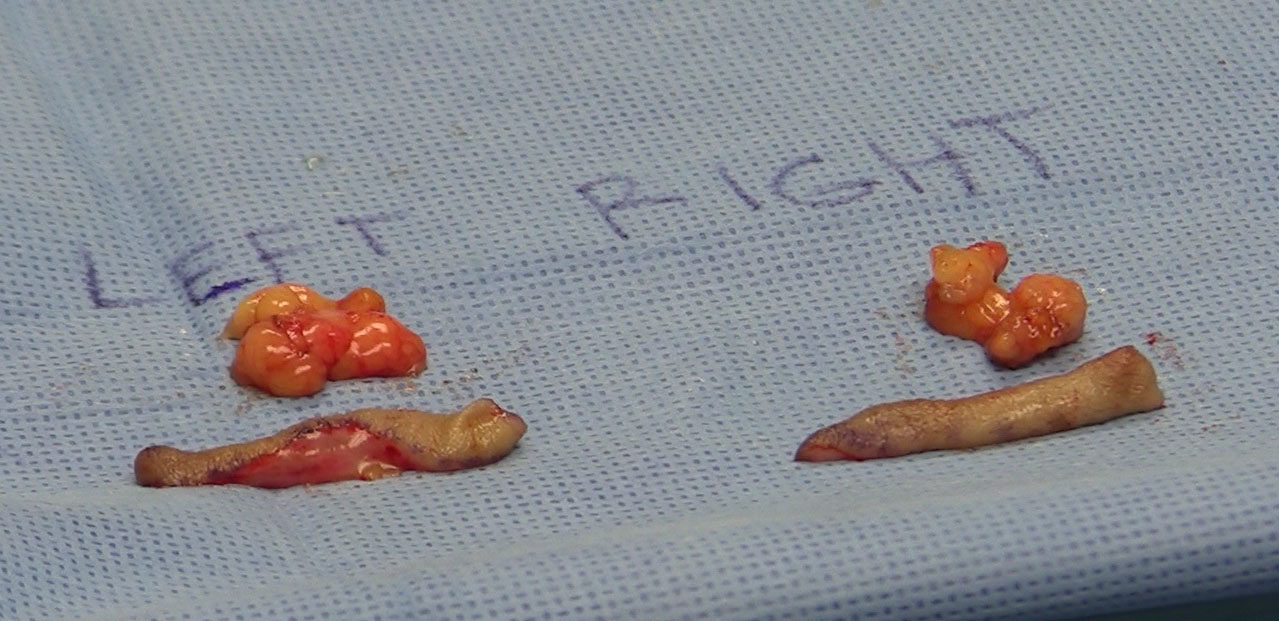 Excised skin and fat tissue from eyelid surgery