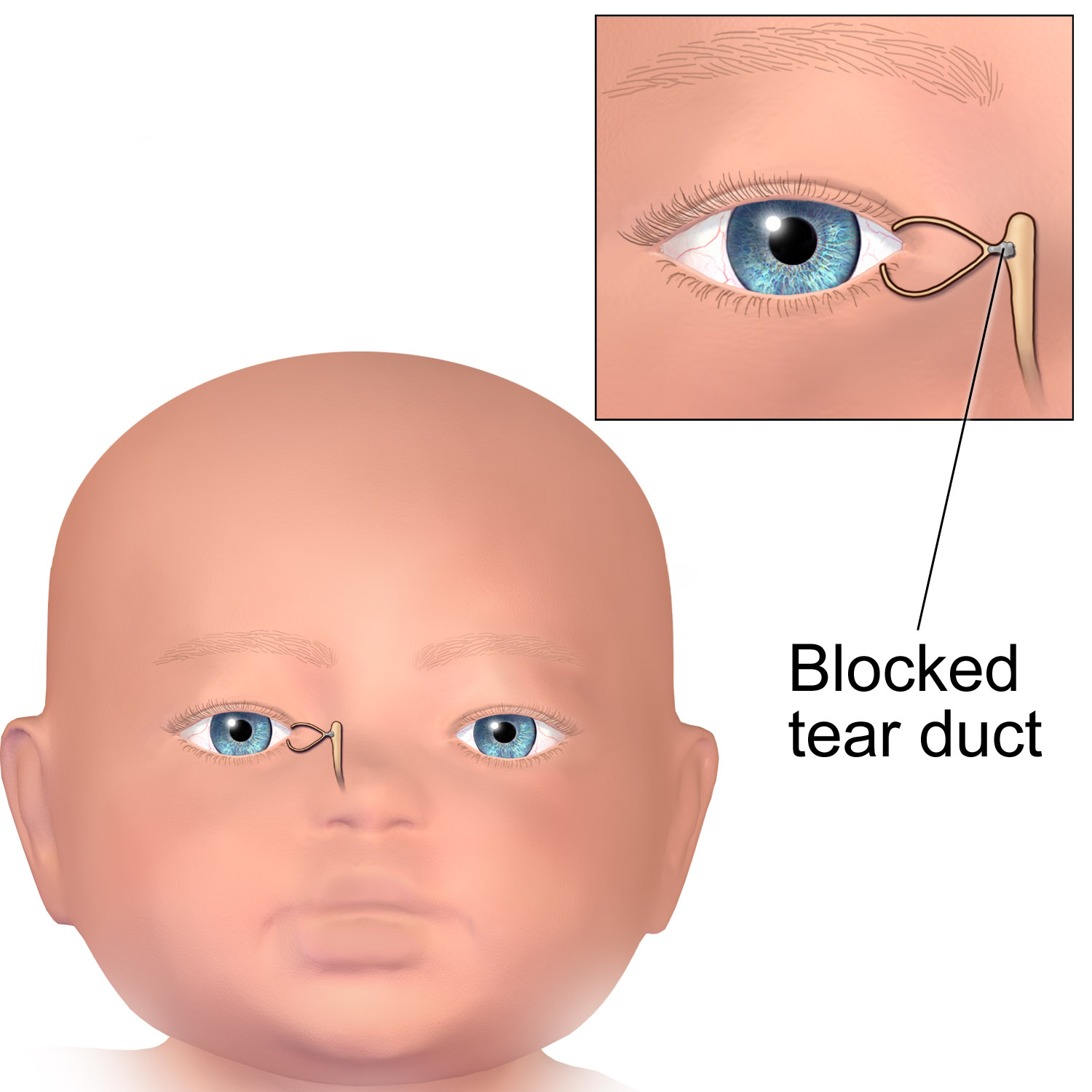 Medical illustration of an infant with a blocked tear duct.