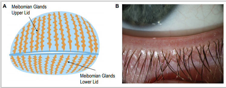 Composite image with a schematic of meibomian glands and a close-up eyelid margin photo.