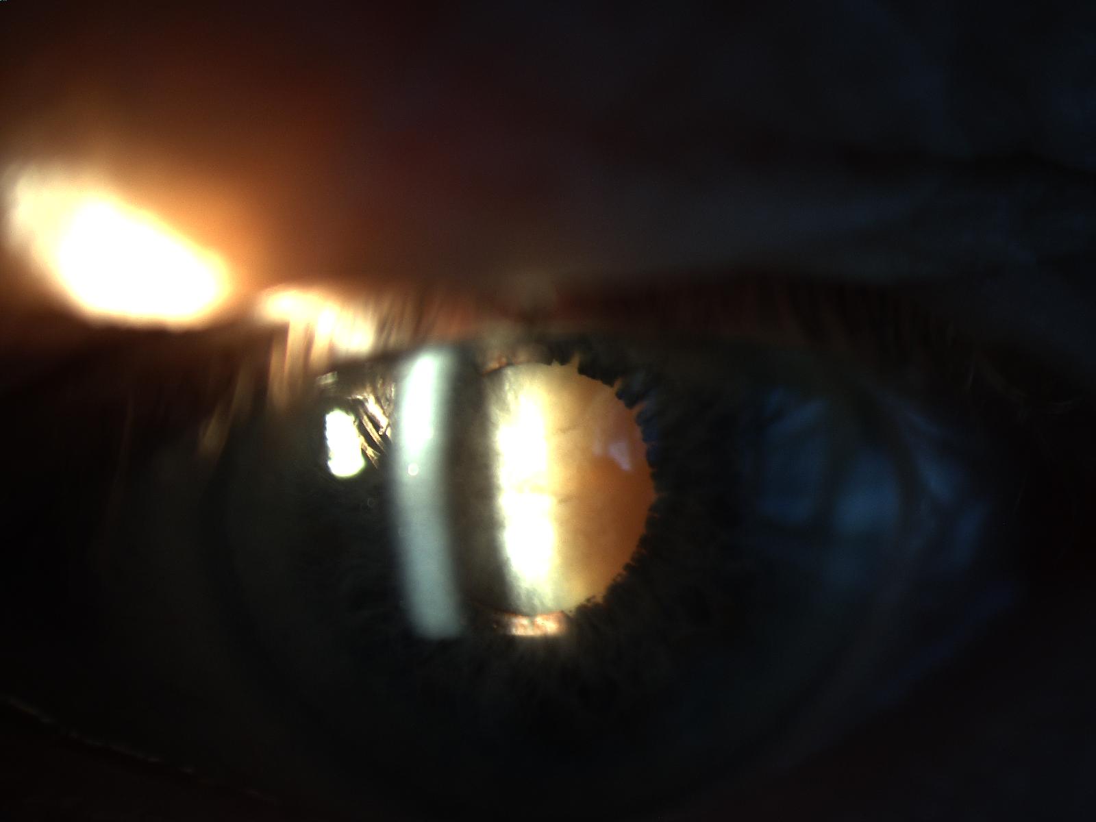 Slit-lamp photo showing a mature, cloudy lens