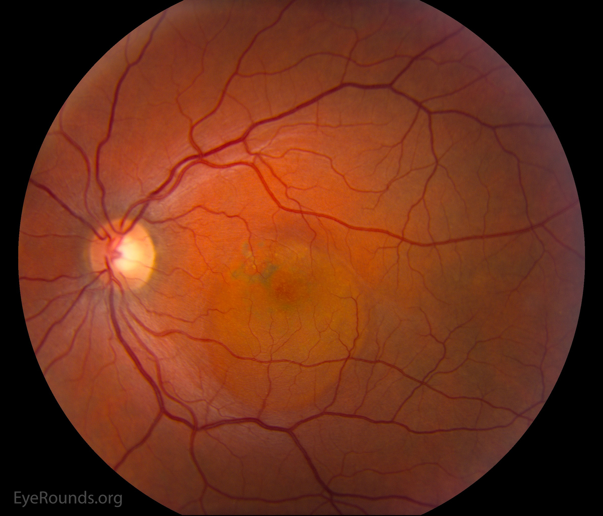 Color fundus photograph showing a dome-shaped serous macular detachment in central serous retinopathy.