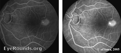 Early and late fluorescein angiography frames demonstrating a focal leakage point with classic smoke-stack pooling.