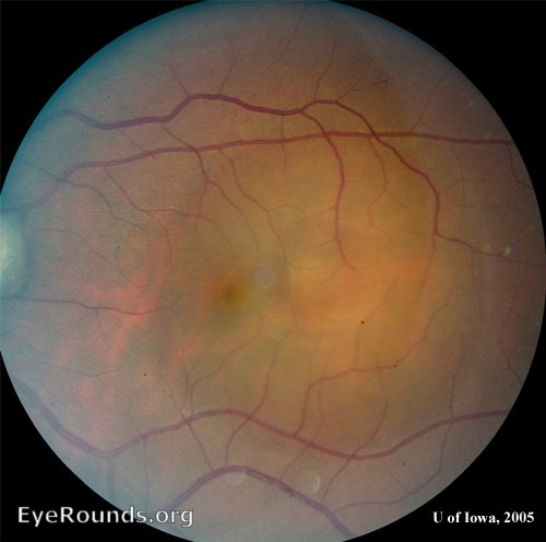 Fundus image after chronic CSR showing granular retinal pigment epithelium changes.