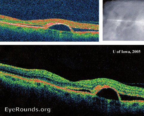 Optical coherence tomography scan depicting sub-retinal fluid and a pigment-epithelial detachment.