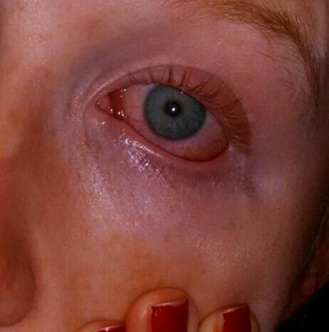 Photo showing an eye with actinic conjunctivitis, marked by redness and swelling.