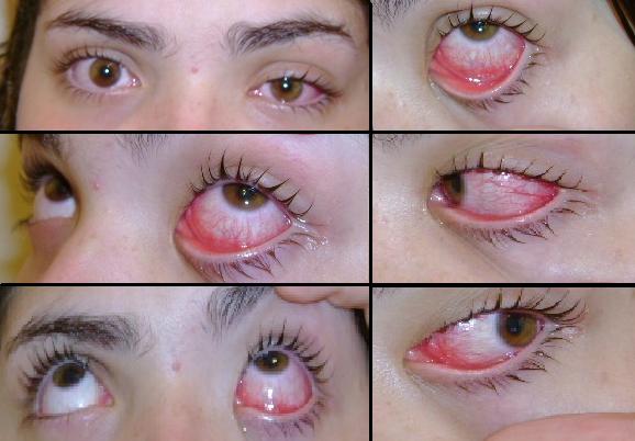 Collage of six close‑up photos showing an eye with conjunctivitis from multiple angles.