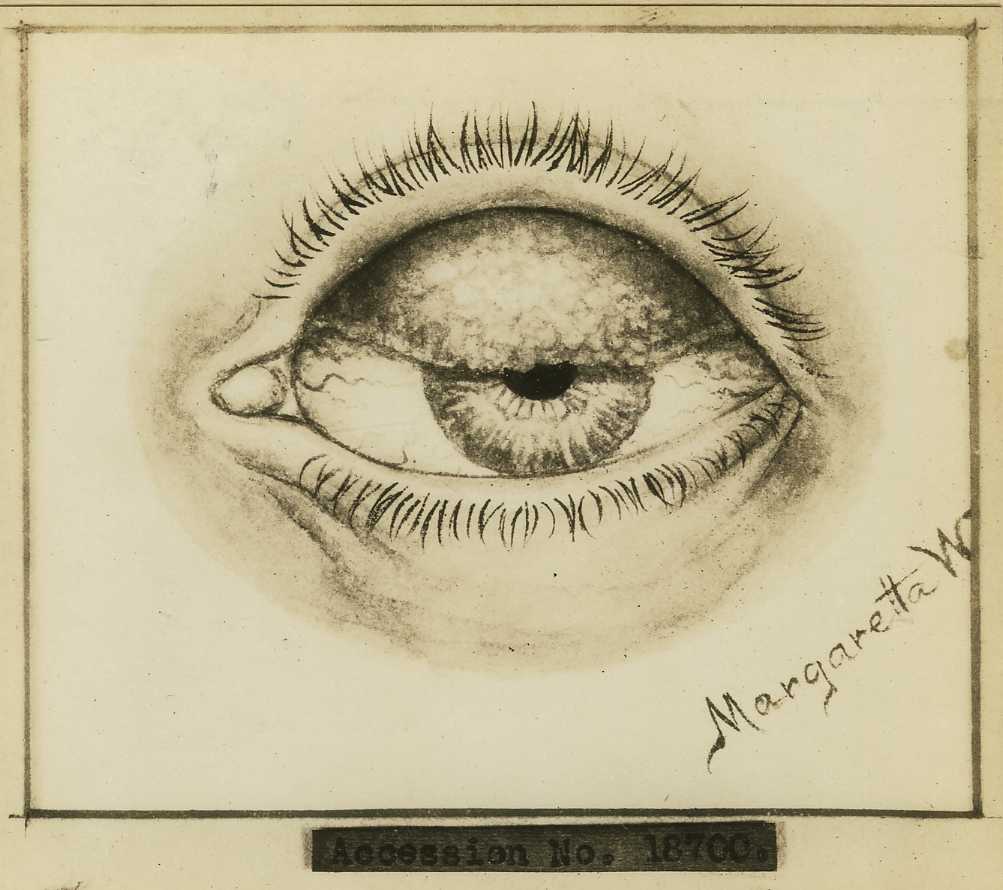 Vintage medical illustration of vernal conjunctivitis.