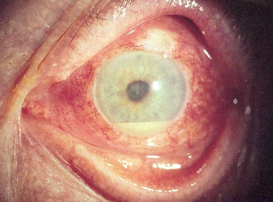 Clinical photograph showing a hypopyon layering in the lower anterior chamber