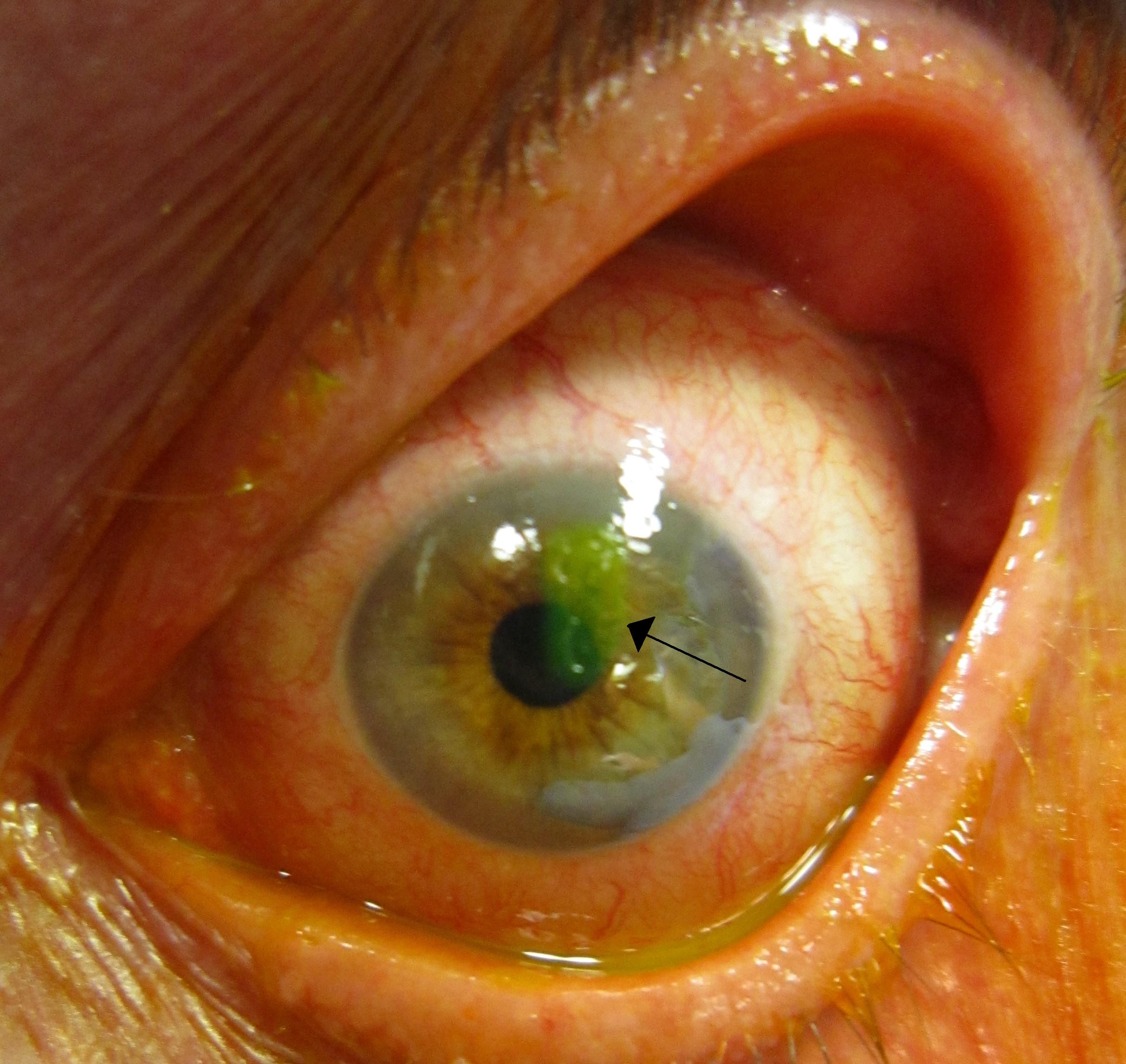Corneal abrasion highlighted by fluorescein staining