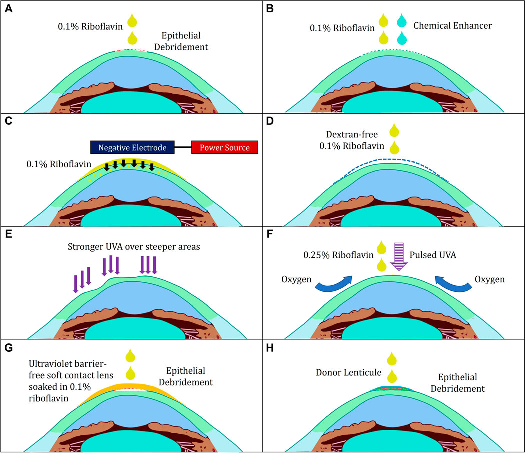 Applying riboflavin drops to the cornea before UVA exposure