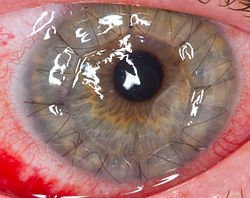 Close-up of an eye one day after penetrating keratoplasty