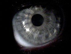 Eye one week after a corneal transplant showing faint suture lines
