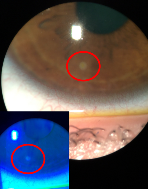 Small contact-lens–related corneal ulcer shown with and without blue light
