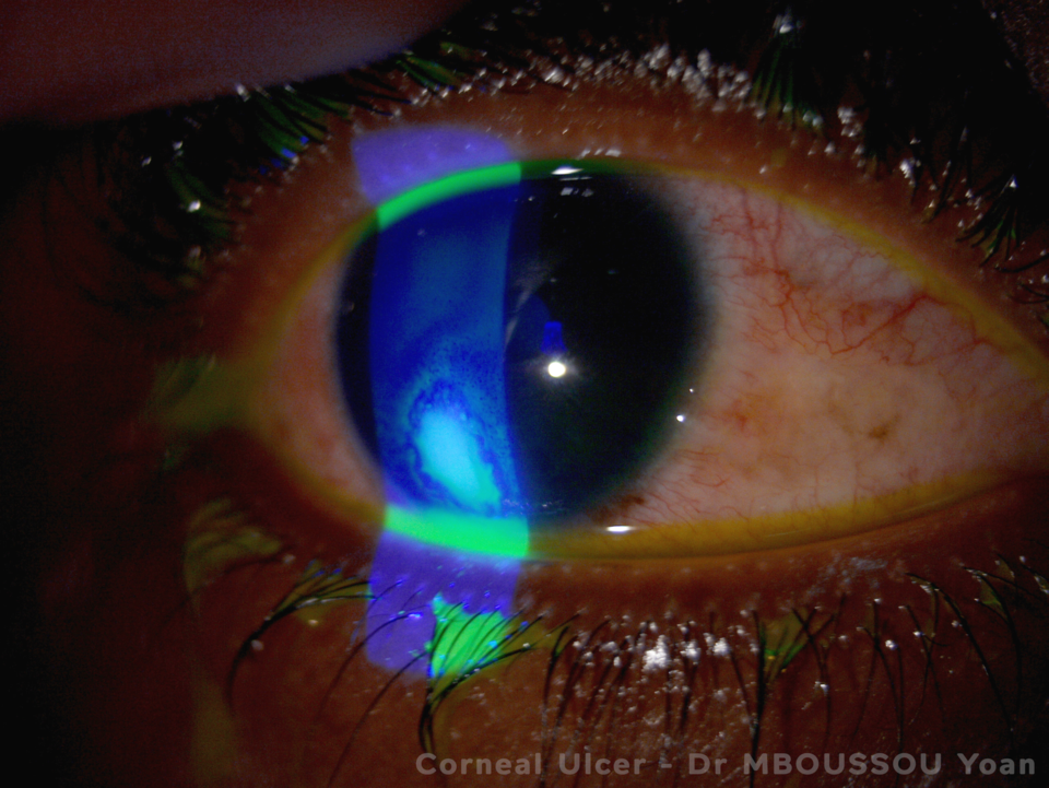 Fluorescein-stained corneal ulcer glowing blue under cobalt light