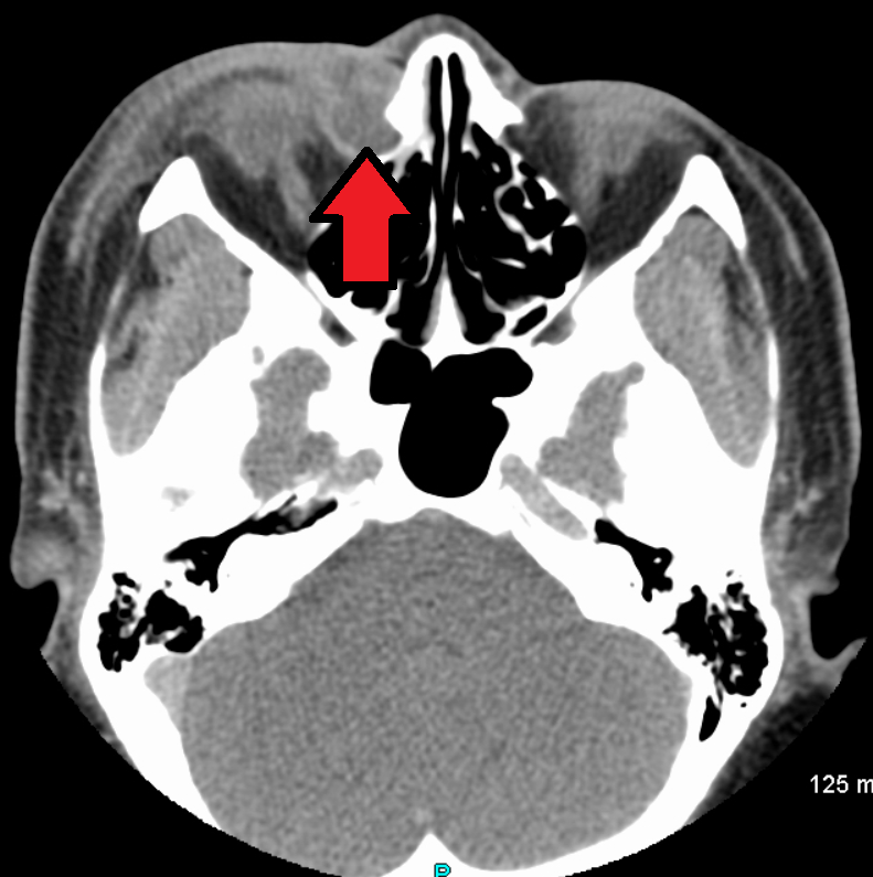 Axial CT of the face with arrow denoting inflamed lacrimal sac area consistent with dacryocystitis.