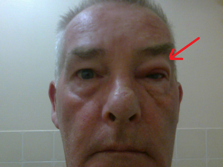 Close-up photo of an eye with blepharitis showing crusting along the eyelid margin
