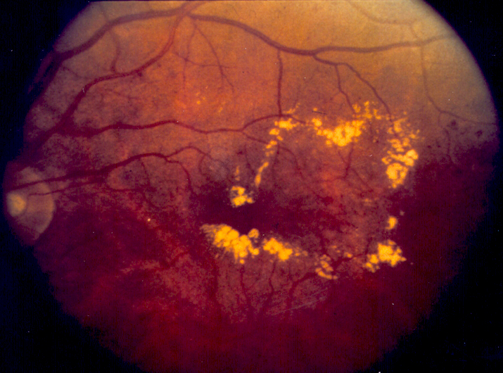 Color fundus photo from the National Eye Institute showing lipid deposits and swelling near the macula in diabetic macular edema