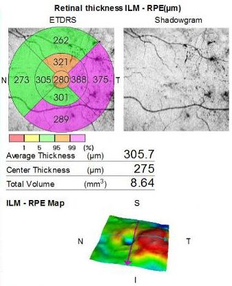 OCT thickness map with colored sectors and 3D view showing increased central retinal thickness