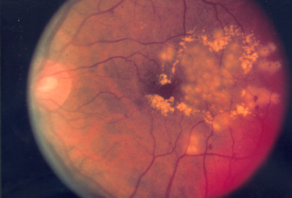 Fundus photograph with yellow lipid exudates from diabetic macular edema