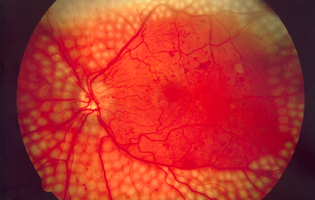 Scatter laser (pan-retinal photocoagulation) scars across the retina