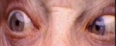 Close-up showing limited outward movement of one eye due to abducens nerve palsy.