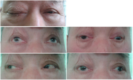 Series of gaze photographs from a patient with oculomotor nerve palsy.