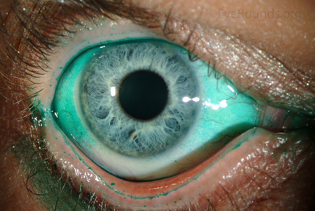 Lissamine green staining highlights damaged conjunctiva in severe dry eye