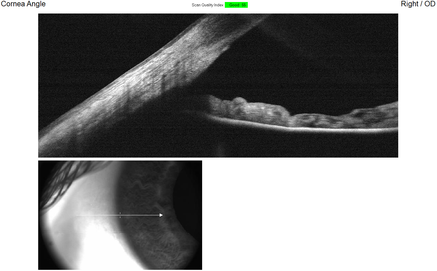 Anterior segment OCT cross-section showing the anterior chamber angle