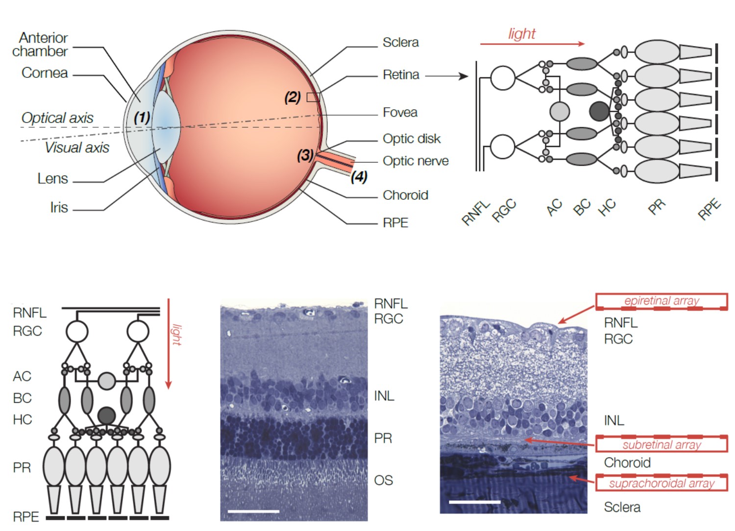 Diagram of eye anatomy and potential locations for retinal implants
