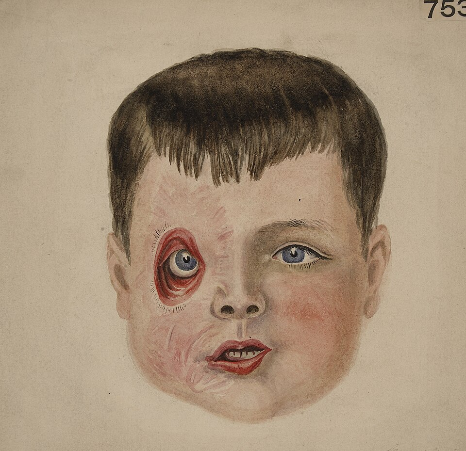 Painting of outward-drooping lower lid (ectropion) after a burn injury