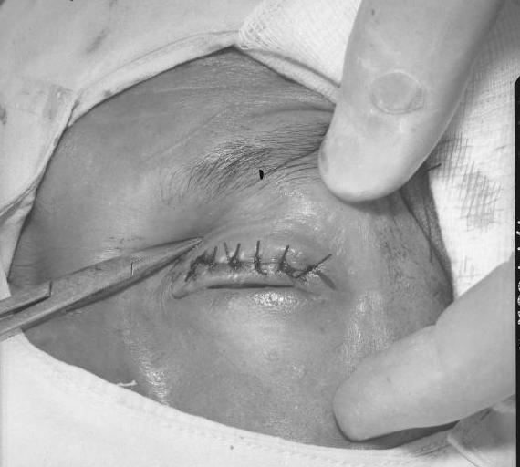 Historic photo showing inward-turned lower lid (entropion) with lashes scraping the eye