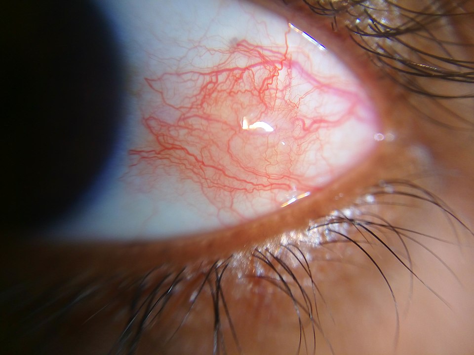 Close-up photo of sectoral episcleritis showing bright red vessels over the white sclera