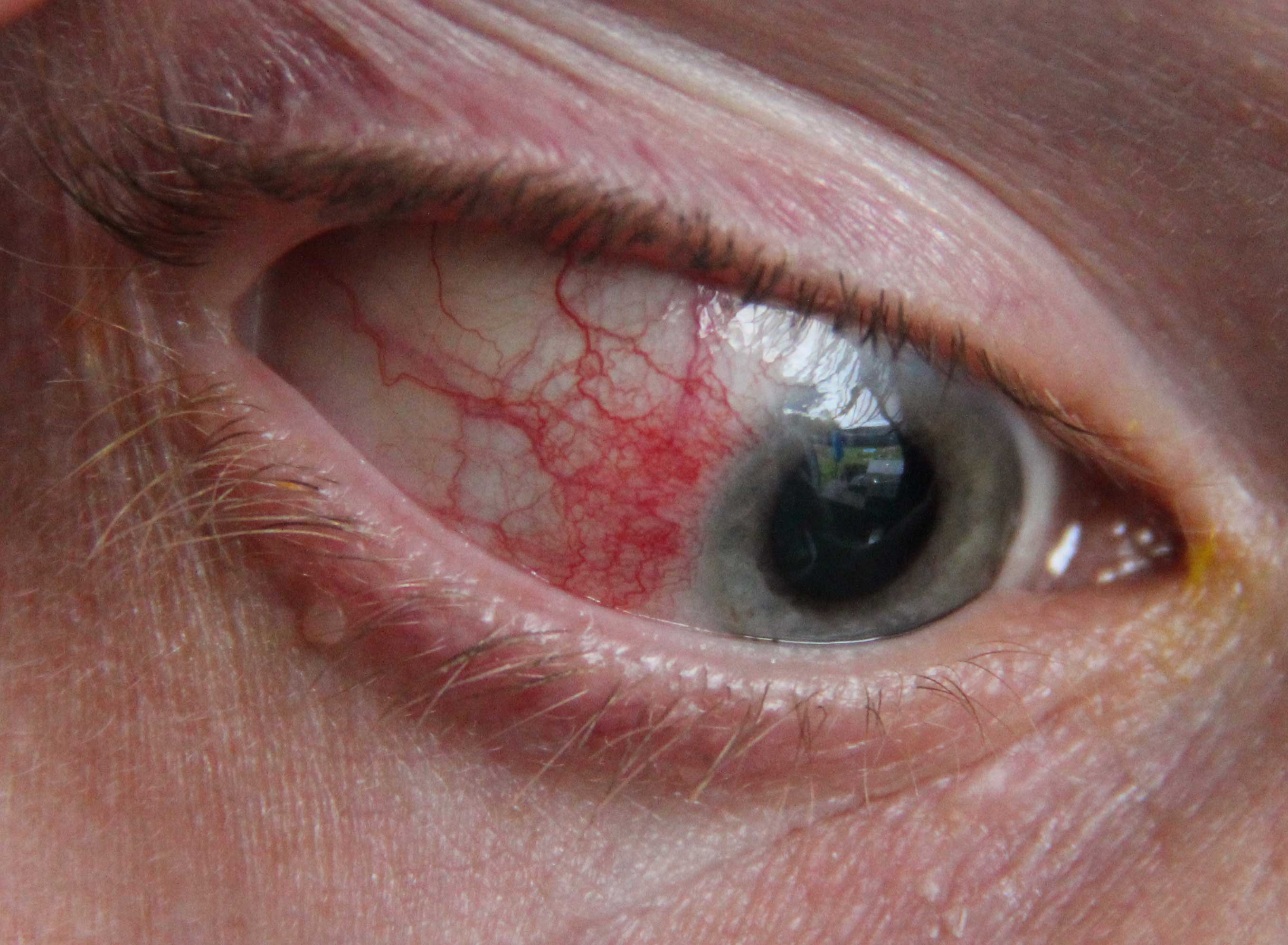 Diffuse episcleritis with generalized redness
