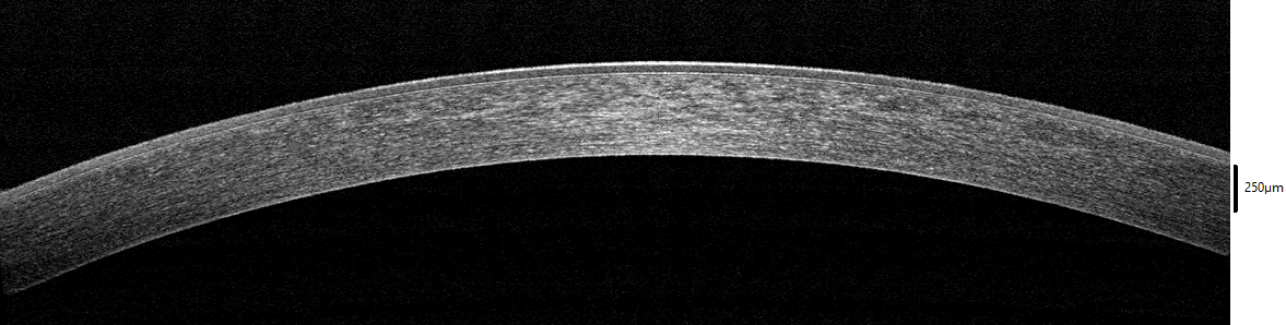 Anterior segment OCT cross-section of the cornea